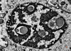 F,52y. | intranuclear inclusions - plasmocytoma